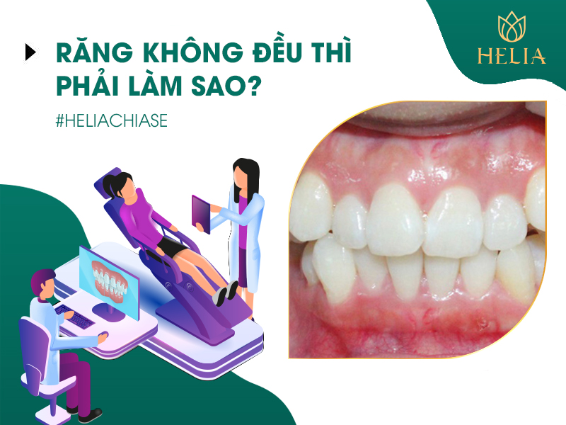 Khách hàng sử dụng dịch vụ bọc răng sứ Pico Zolid Đức khắc phục tình trạng răng không đều