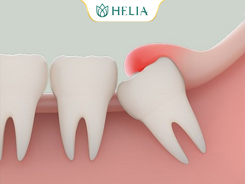 Lợi trùm khiến quá trình phát triển răng gặp khó khăn gây nhiều biến chứng