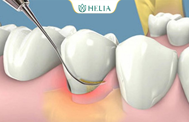 Lấy cao răng thường xuyên cho răng miệng khỏe mạnh