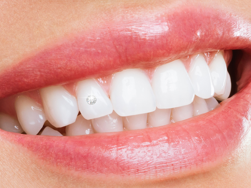 Kỹ thuật đính đá răng trở thành xu hướng làm đẹp “gây sốt” với thời gian thực hiện vô cùng nhanh chóng 