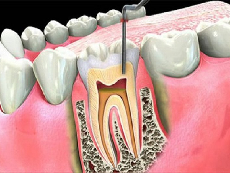 Một số trường hợp cần điều trị tủy răng