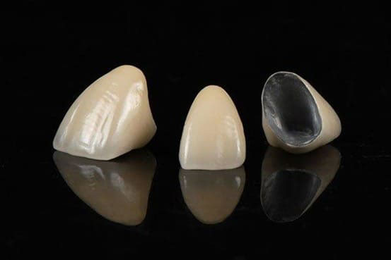 Cận cảnh răng sứ titan thường được sử dụng