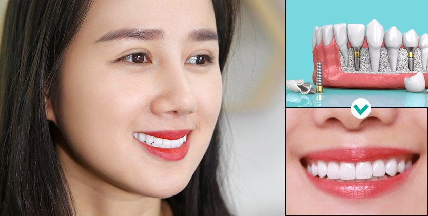 KH. DIỆU HÀ - Cấy ghép răng Implant Hàn Quốc